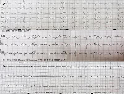 Takotsubo syndrome and atrial myxoma—identifying a new trigger: a case report